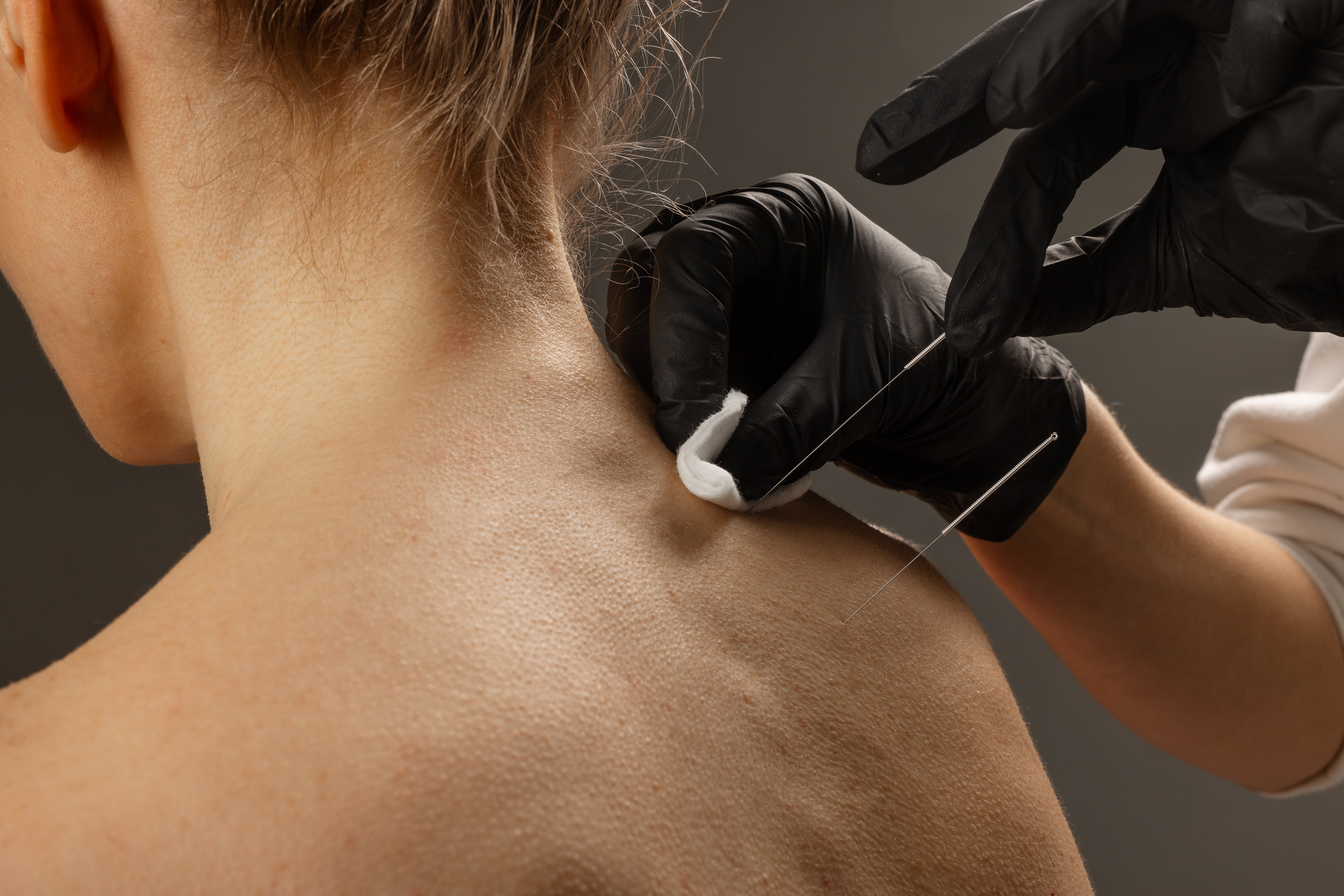 dry needling